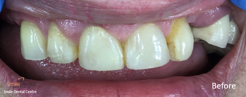 Composite veneer and removable denture
