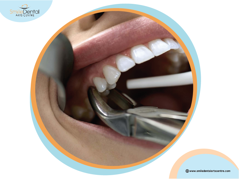 Simple Tooth Extractions: What You Need to Know