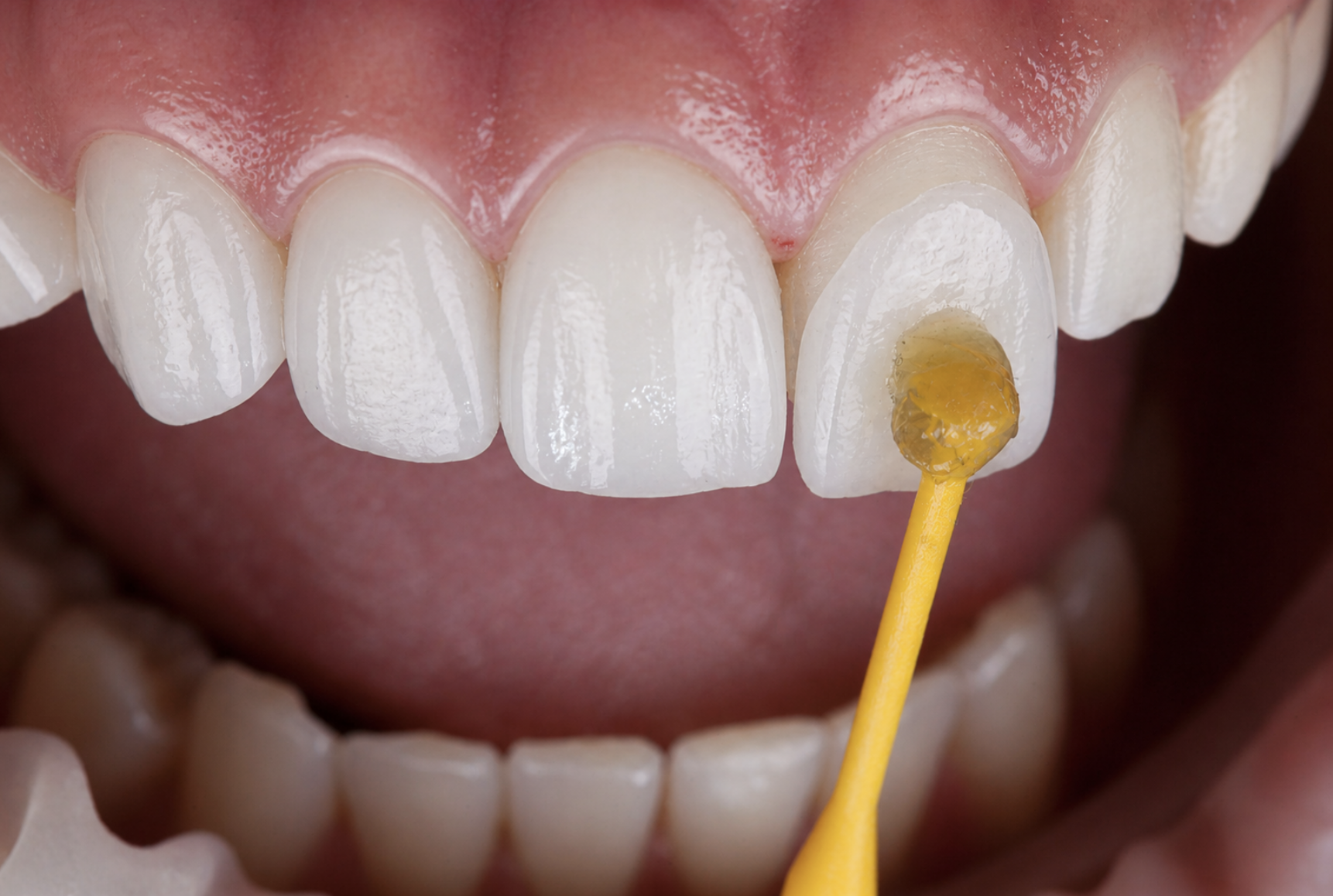 Dental Veneer Markham