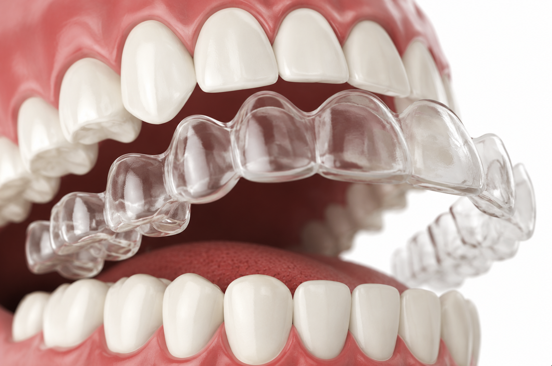 Invisalign Markham