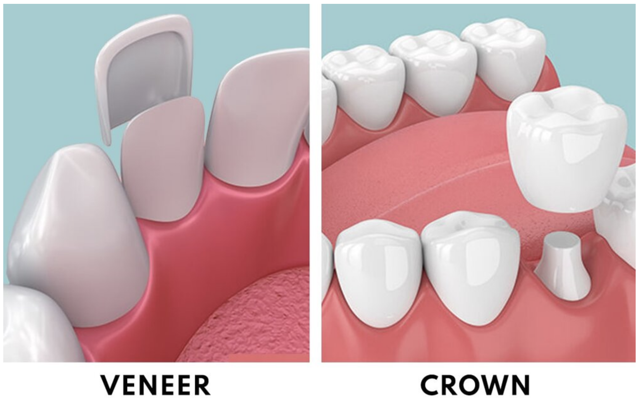 Porcelain Veneers